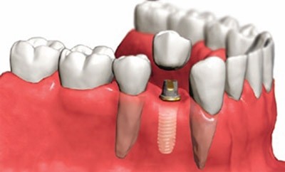 Nueva técnica revolucionaria el mundo de implantes dentales